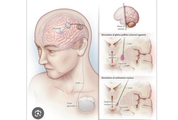 Functional Neurosurgery
