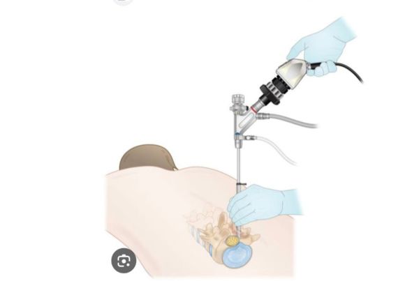 Endoscopic Spine Surgery